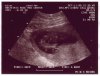 Ultrasound Picture No. 1 - Small version