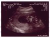 Ultrasound Picture No. 3 - Small version