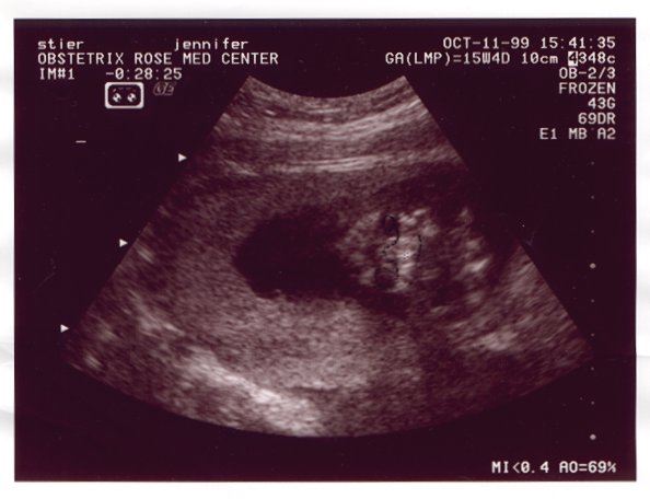 Ultrasound Picture No. 3