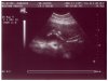 Ultrasound Picture No. 4 - Small version