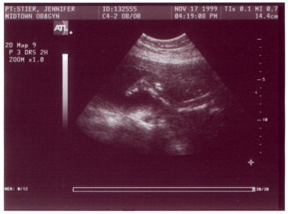 Ultrasound Picture No. 4
