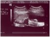 Ultrasound Picture No. 5 - Small version