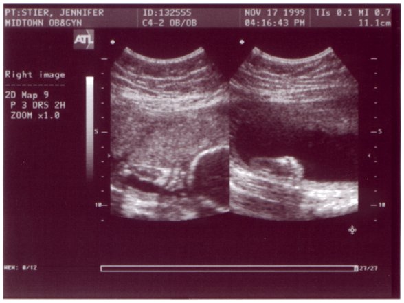 Ultrasound Picture No. 5