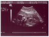 Ultrasound Picture No. 6 - Small version