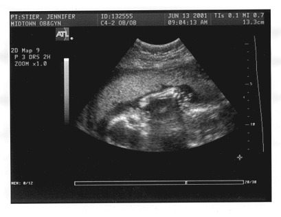 Ultrasound Picture